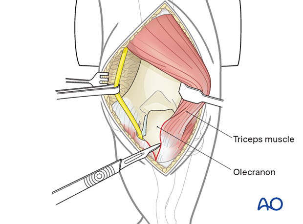 At the level of the olecranon, detach the extensor apparatus subperiosteally or with a sliver of bone using a fine osteotome.