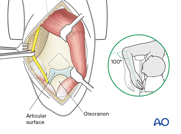 Flex the elbow beyond 100° to enhance visualization of the articular surface.
