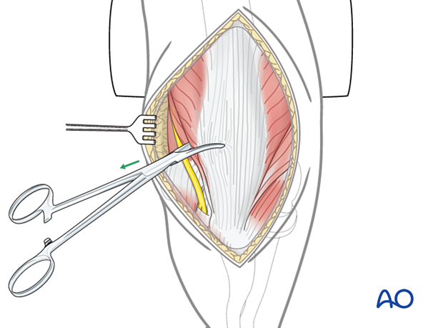 Pulling the extensor apparatus into place with a Kocher forceps