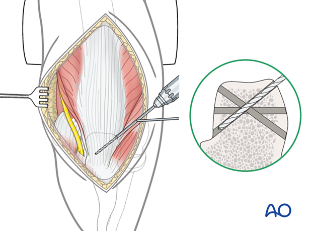 Reattachment of the triceps tendon insertion to the olecranon with transosseous sutures: drilling of transosseous tunnels