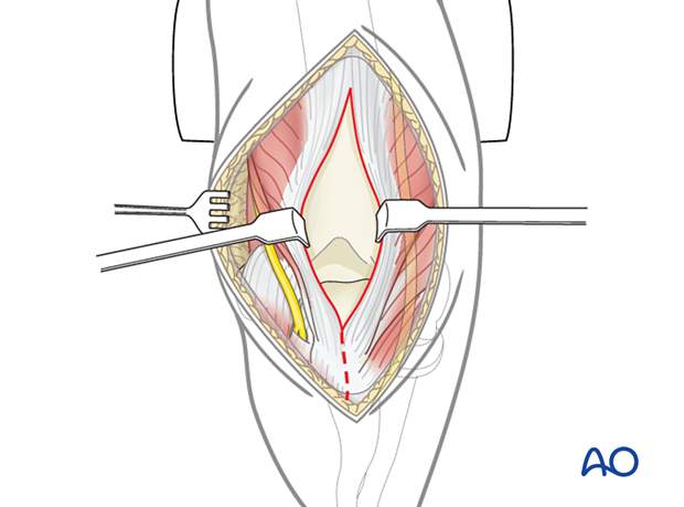 Posterior triceps-split approach (Campbell): Subperiosteal dissection of the tendon and associated soft-tissue attachments of the ulna should be performed carefully.
