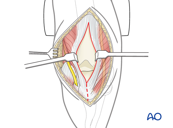 Posterior triceps-split approach (Campbell) to the distal humerus