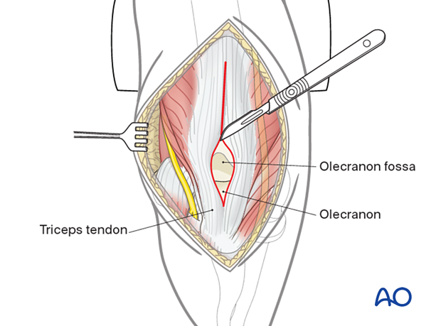 Split of the triceps tendon