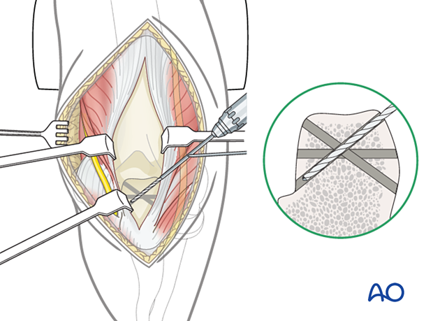 Preparation of transverse and oblique transosseous tunnels in the olecranon