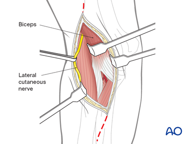 Anterior approach to the capitellum to the distal humerus