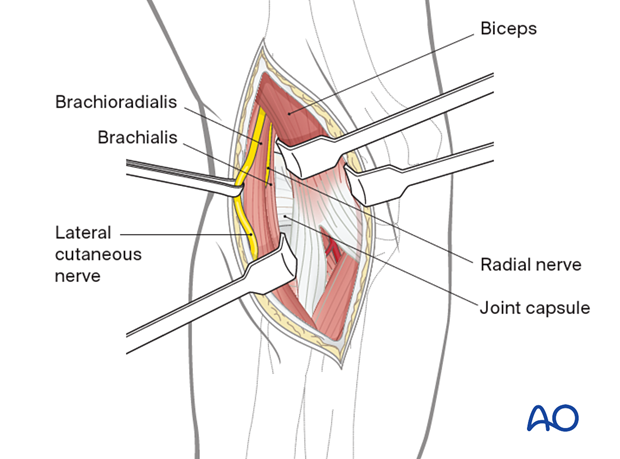 The brachioradialis and brachialis can now be safely retracted with protection of the radial nerve to allow identification of the anterior joint capsule.