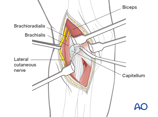 Incise the joint capsule longitudinally to allow access to the capitellum and lateral trochlear ridge.