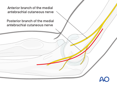 Medial approach to the distal humerus