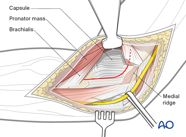 The planned capsulotomy is marked in red.