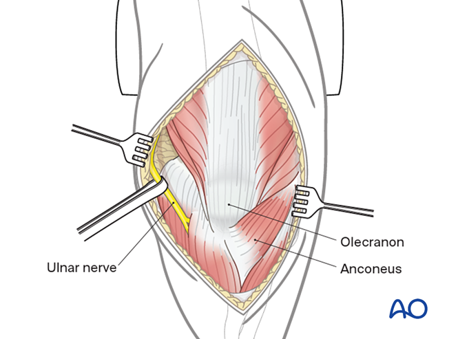 Lateral paraolecranon approach to the distal humerus