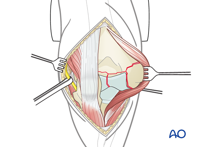 Lateral paraolecranon approach to the distal humerus