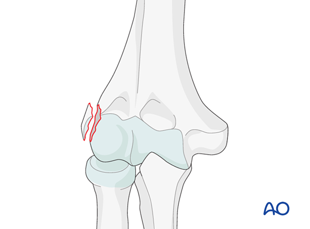 Avulsion of lateral epicondyle
