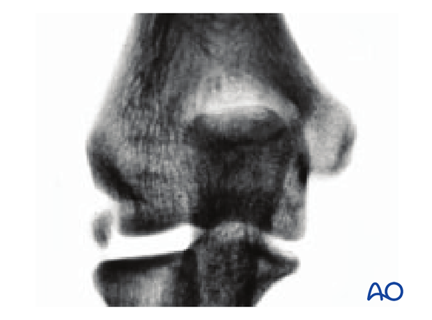 X-ray of avulsion of lateral epicondyle