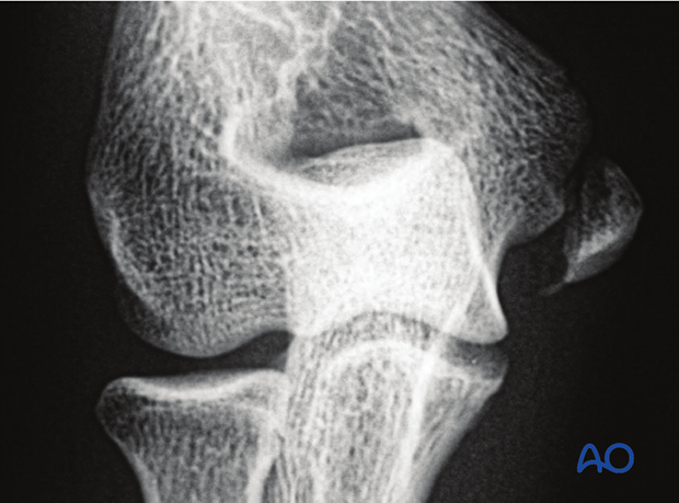 X-ray of avulsion of medial epicondyle