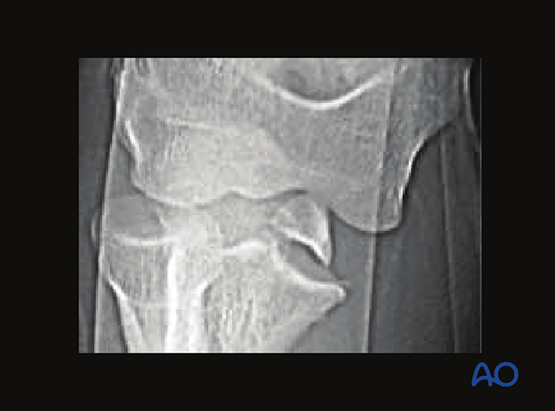 X-ray of incarcerated medial epicondylar fragment