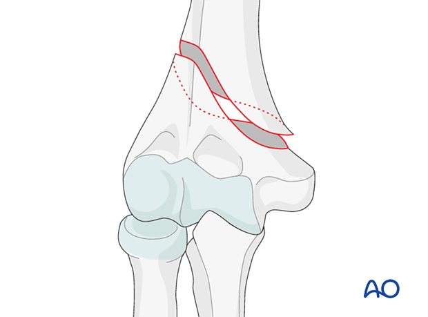 Extraarticular, simple spiral fracture