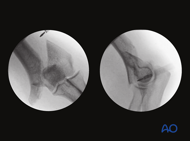 X-ray of extraarticular, simple spiral fracture