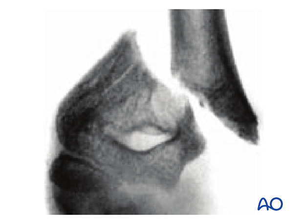 AP x-ray showing an extraarticular fracture, obliquely distal and medial