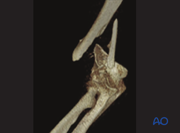 3-D CT reconstruction of extraarticular wedge fracture