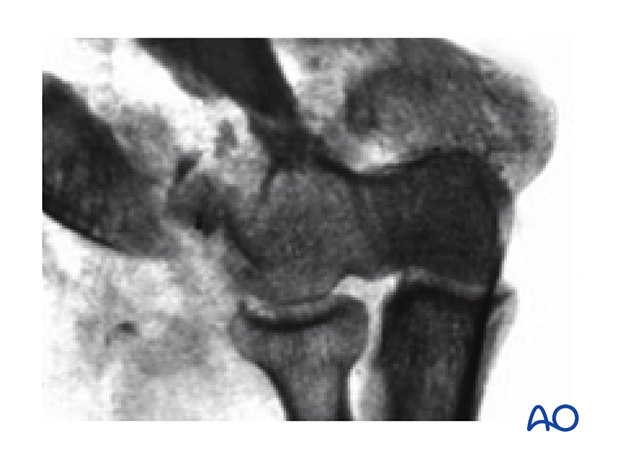 X-ray of extraarticular wedge fracture