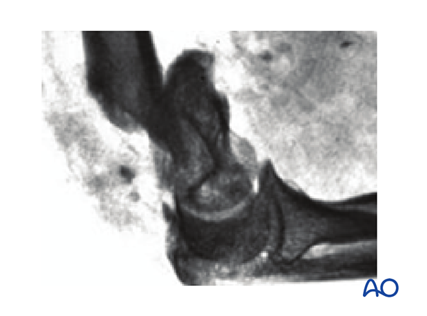 X-ray of extraarticular wedge fracture