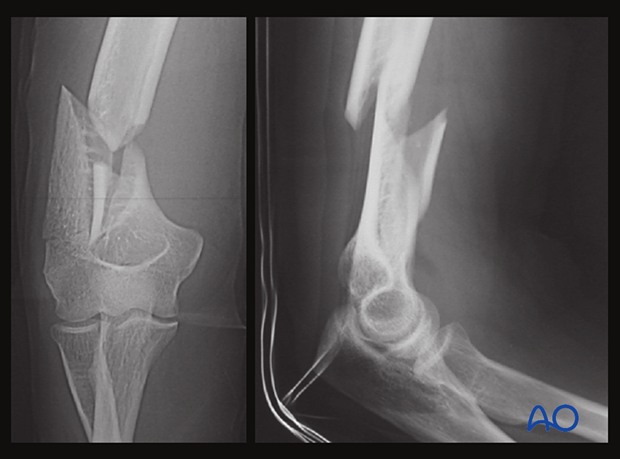 X-ray of extraarticular, multifragmentary fracture