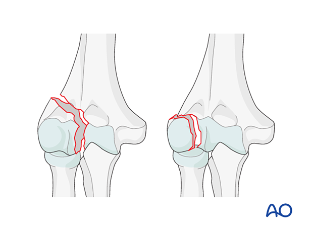 Partial articular, lateral sagittal, simple transtrochlear and capitellar fracture