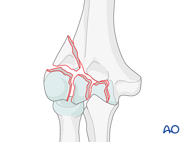 Partial articular, lateral sagittal, fragmentary transtrochlear fracture