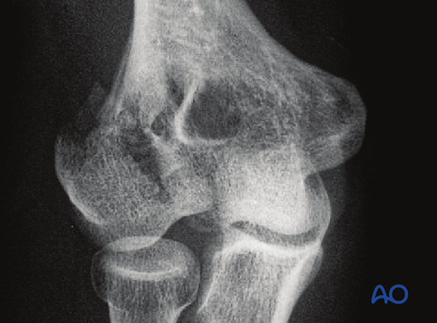 X-ray of partial articular, lateral sagittal, fragmentary transtrochlear fracture