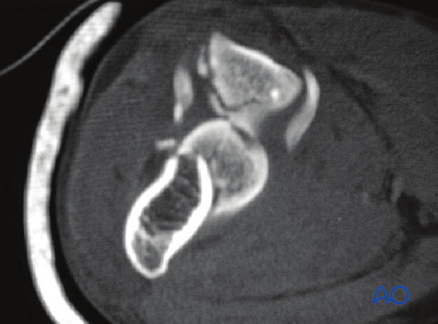 2-D CT scan of partial articular, simple medial sagittal fracture through trochlear groove