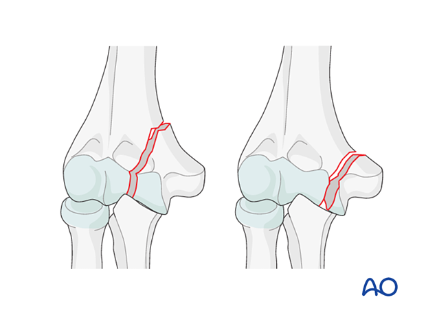 Partial articular, simple medial sagittal fracture through the trochlear groove and the medial trochlear ridge