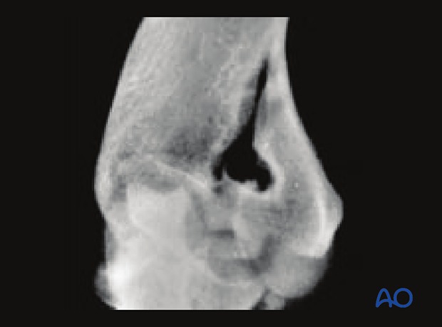 X-ray of partial articular, fragmentary transtrochlear medial sagittal fracture