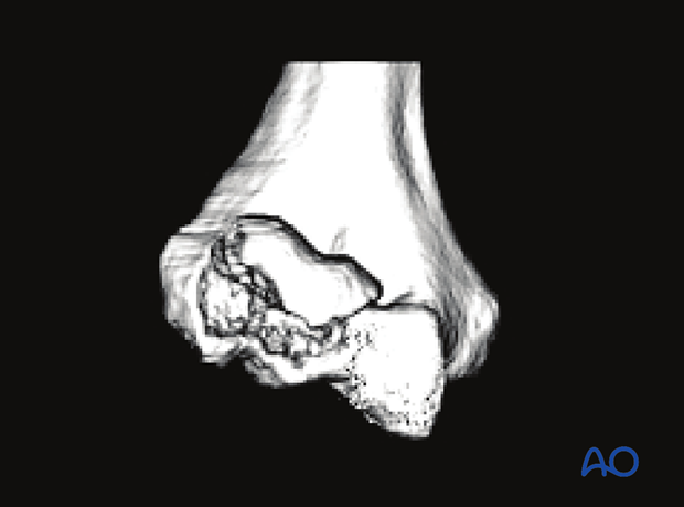 3-D CT reconstruction of a capitellar fracture with extension into the lateral trochlea