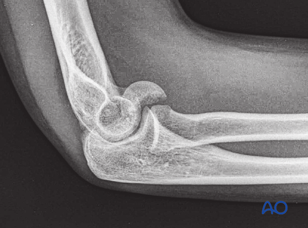 X-ray of capitellar fracture