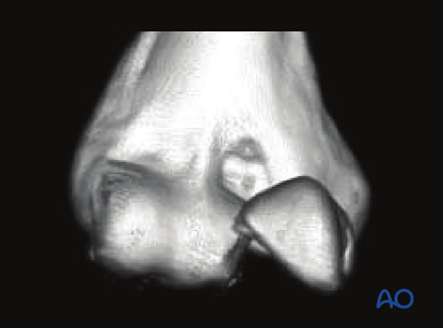 3-D CT reconstruction of a trochlear fracture