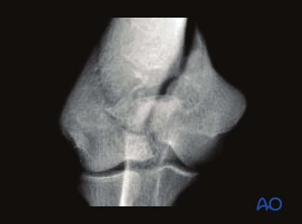 X-ray of complete simple articular and simple metaphyseal fracture