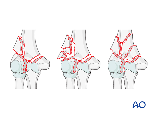 Complete simple articular and wedge or multifragmentary metaphyseal fracture