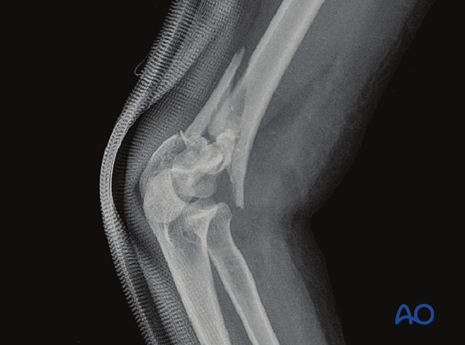 Complete articular fracture, simple articular, wedge or ...