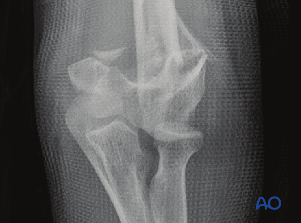 AP x-ray of a complete simple articular, metaphyseal wedge fracture