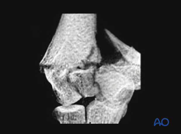 Complete articular fracture, multifragmentary articular