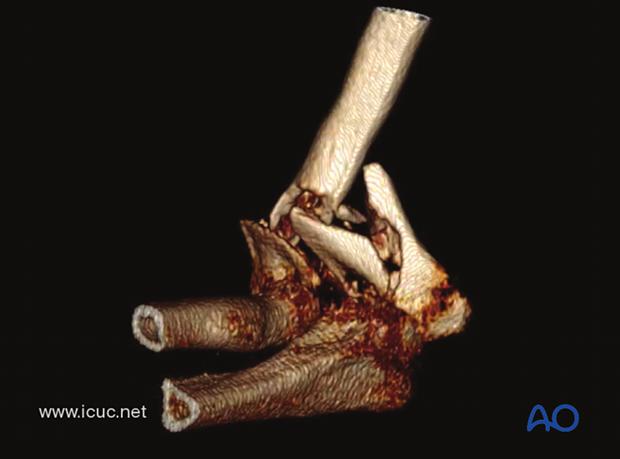 3D-CT demonstrating a C-type distal humeral fracture with much comminution