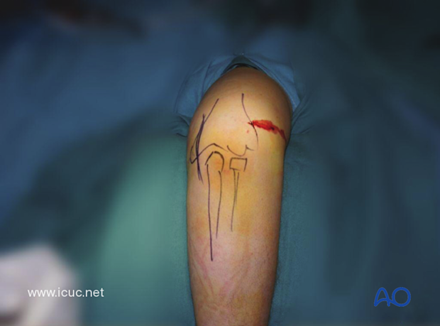 The surgical anatomy has been drawn on the patient's elbow and a small, lateral, grade 1 open wound is present.