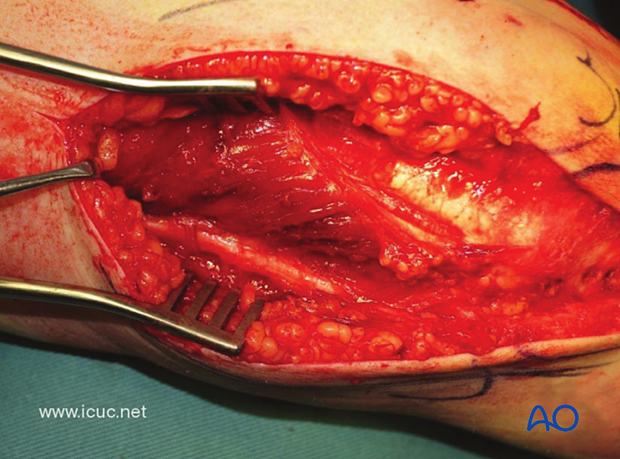 The ulnar nerve is carefully dissected and protected on the medial side.