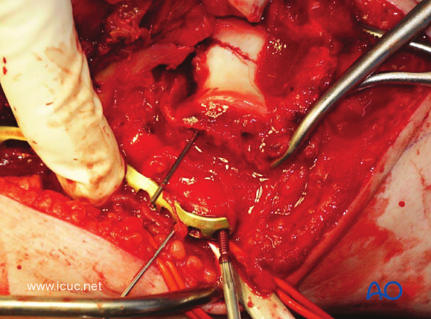 The medial LCP may be used as a reduction plate with locking screws distally assisting with transcondylar fixation.