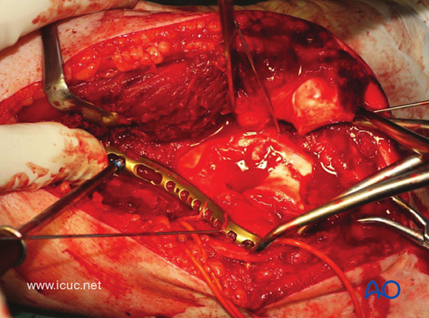 Once the metaphyseal component is reduced, proximal fixation can be performed.