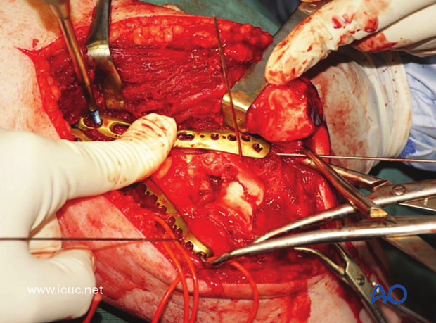 Great care must be taken to ensure that the distal end of the lateral plate is clear of the olecranon fossa, so as not to compromise extension of the elbow.