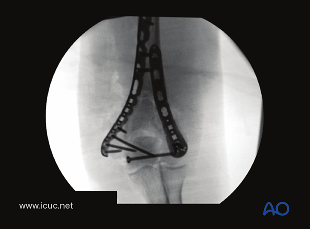AP X-ray demonstrates the lag screw reducing the articular fracture and nice, two-sided, stable fixation.