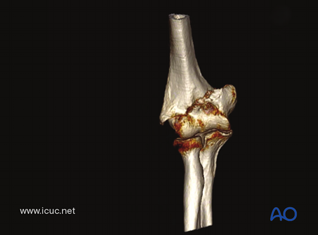 This 3D-CT shows a low transcondylar/supracondylar distal humeral fracture.
