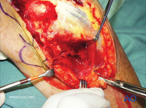 The first task is to carefully dissect medially to identify and protect the ulnar nerve.