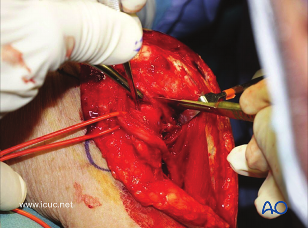 This image also shows dissection of the olecranon for osteotomy placement.
